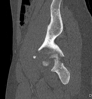 Acetabular Fracture Posterior Column 2